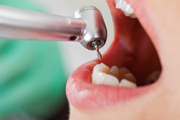 Best Emergency Treatment for Dental Infections or Abscesses in Coalinga, CA